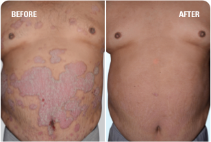Psoriasis on chest and stomach before and after SKYRIZI treatment