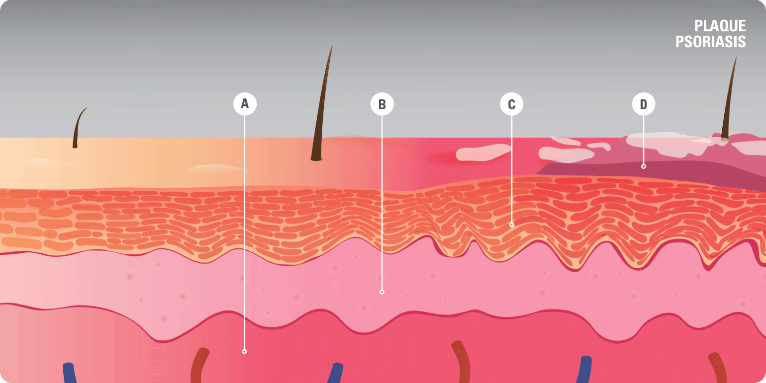 Skin with plaque psoriasis