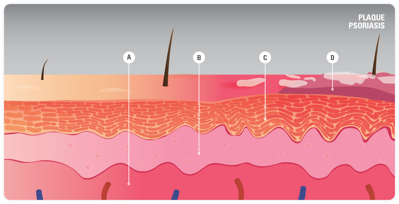 Plaque Psoriasis