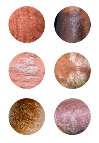 Plaque psoriasis skin types