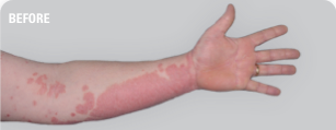 Psoriasis on arms before SKYRIZI treatment