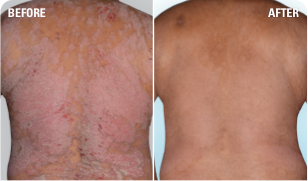 Psoriasis on upper back before and after SKYRIZI treatment