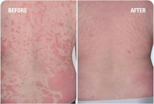 Psoriasis on back before and after SKYRIZI treatment