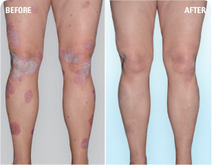 Psoriasis on legs before and after SKYRIZI treatment