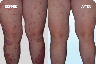Psoriasis on legs before and after SKYRIZI treatment