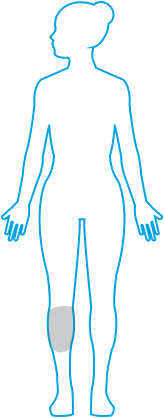 Graphic of Plaque Psoriasis on Body