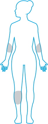 Graphic of Plaque Psoriasis on Body