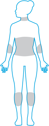 Graphic of Plaque Psoriasis on Body