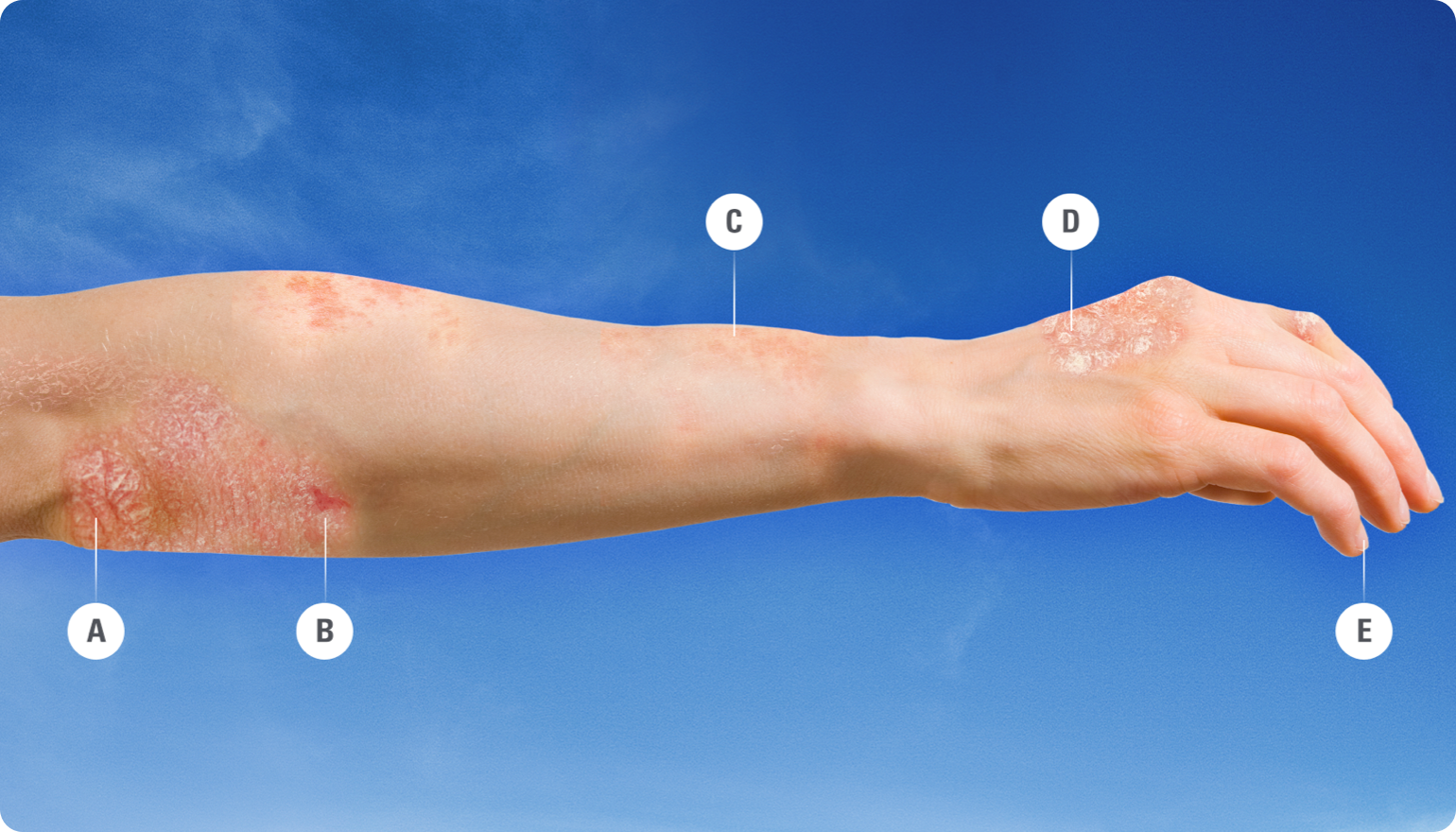 Plaque Psoriasis Signs And Symptoms