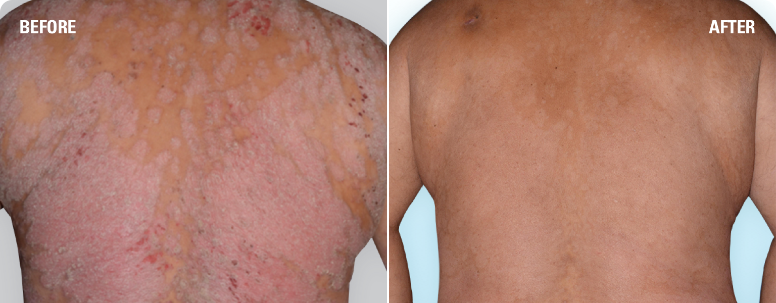 Before & After Pictures SKYRIZI® (risankizumab‐rzaa)
