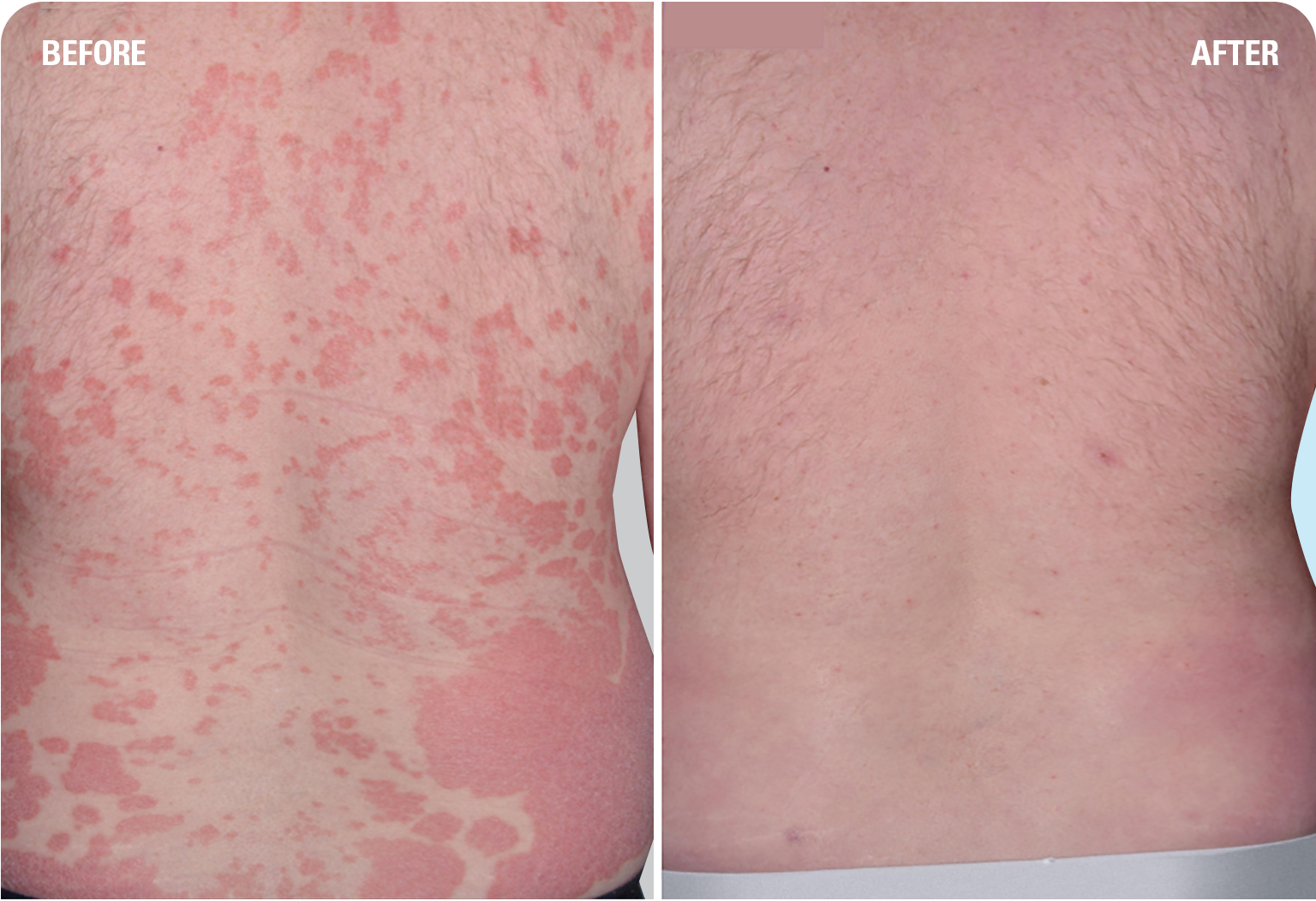 Before & After Pictures SKYRIZI® (risankizumab‐rzaa)