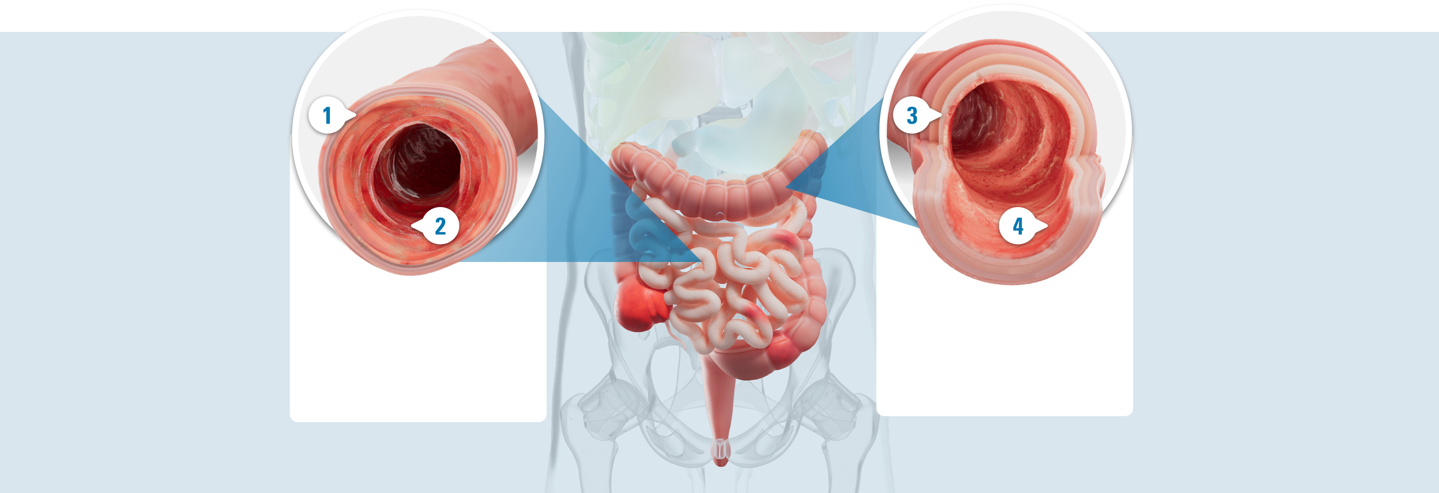 Illustrated colon with 4 callouts: 1. Less inflammation. 2. Less redness. 3. Fewer ulcers. 4. Less bleeding.
