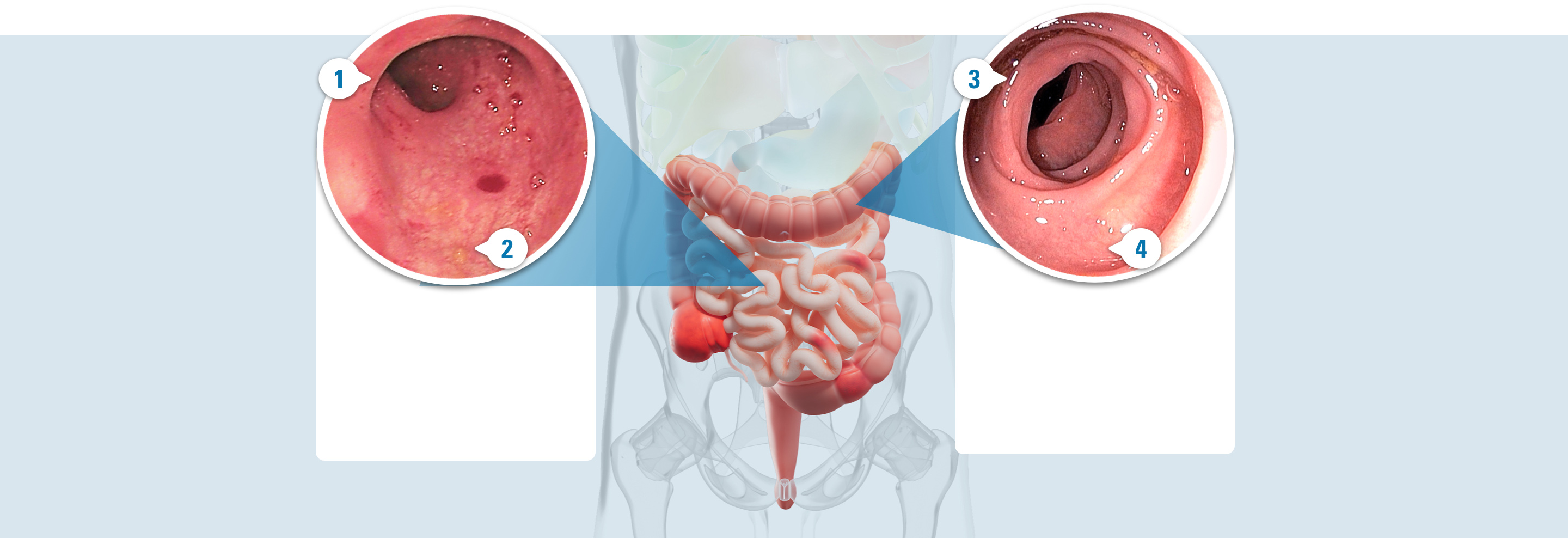 Photo of a colon with 4 callouts: 1. Less inflammation. 2. Less redness. 3. Fewer ulcers. 4. Less bleeding.
