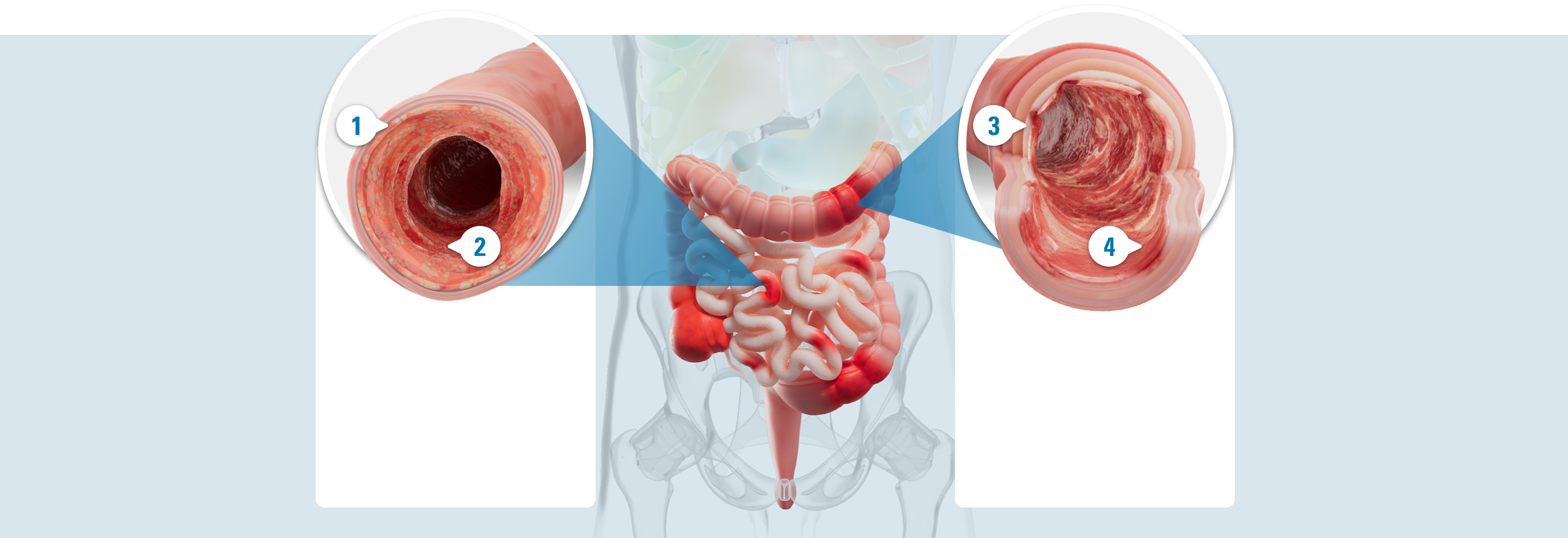 Illustrated damaged colon with 4 callouts: 1. Inflammation, which is an immune response that includes swelling, redness, warmth, and pain. 2. Redness, which is a result of inflammation in the intestinal lining. 3. Ulcers, which are open sores, are caused by inflammation. 4. Bleeding, which is a result of inflammation and open sores (ulcers).