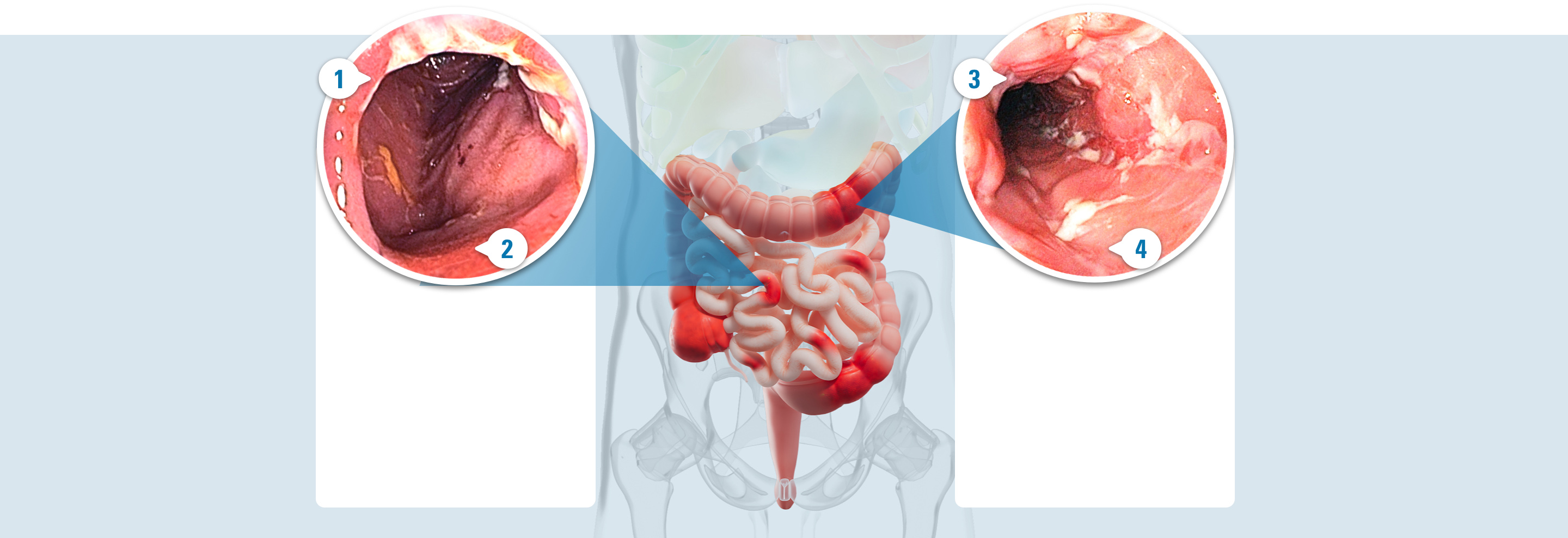 Photo of a damaged colon with 4 callouts: 1. Inflammation, which is an immune response that includes swelling, redness, warmth, and pain. 2. Redness, which is a result of inflammation in the intestinal lining. 3. Ulcers, which are open sores, are caused by inflammation. 4. Bleeding, which is a result of inflammation and open sores (ulcers).