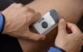 SKYRIZI On-Body Injector on a Person’s Stomach