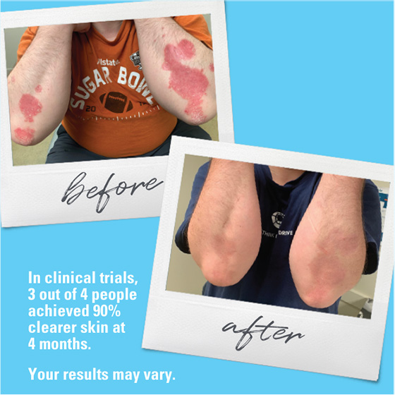 Before and after photos of arms