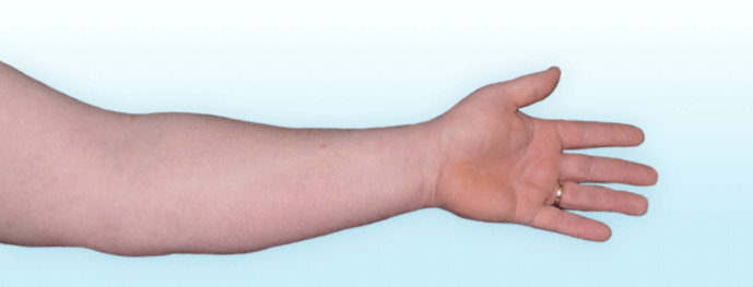 An arm with visible psoriasis plaques before skyrizi and an arm with 100% clearer skin after skyrizi