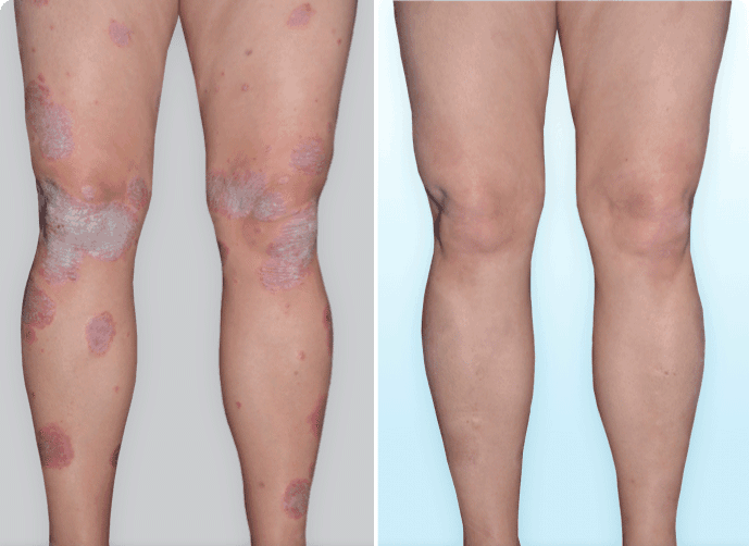 Legs with visible psoriasis plaques before skyrizi and legs with 100% clearer skin after skyrizi