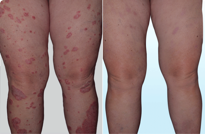 Legs with visible psoriasis plaques before skyrizi and legs with 90% clearer skin after skyrizi