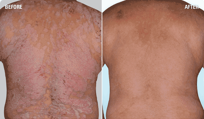 Psoriasis on upper back before and after SKYRIZI treatment