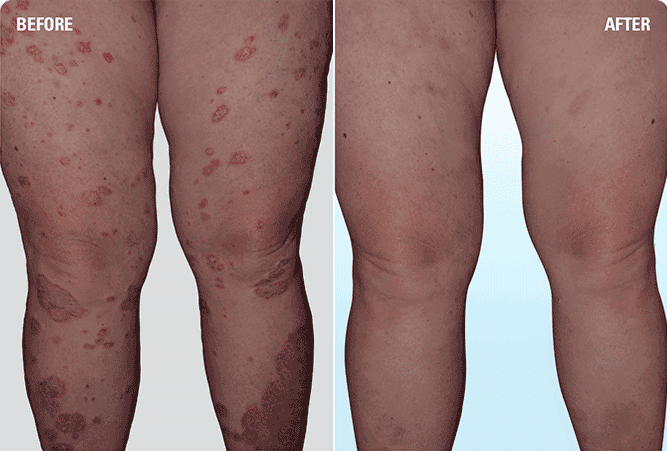 Psoriasis on legs before and after SKYRIZI treatment